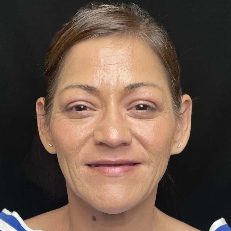 Vanessa before treatment